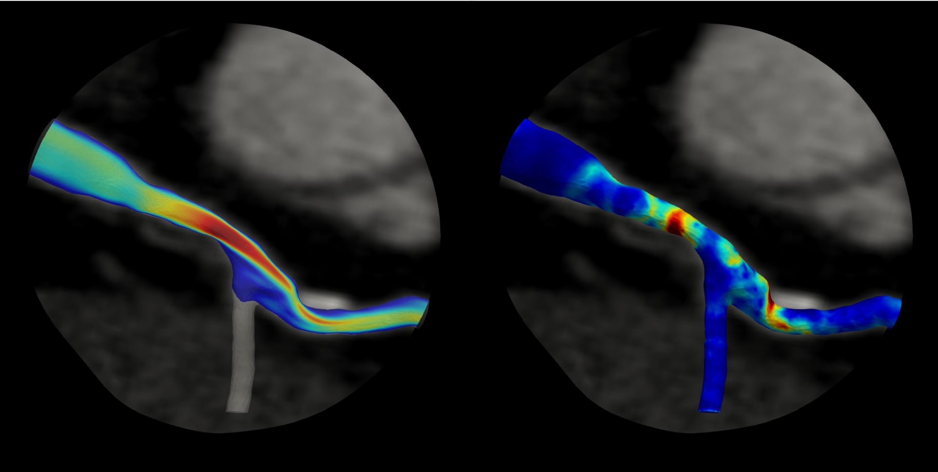 Graphic image of pressure velocity in the heart to better understand blood flow (left) and pressure gradient (right) in heart artery blockages.